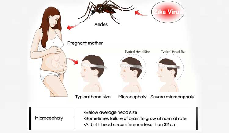 How Zika Virus Affects Pregnancy